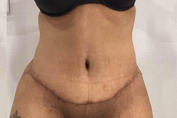 Tummy Tuck case #2140