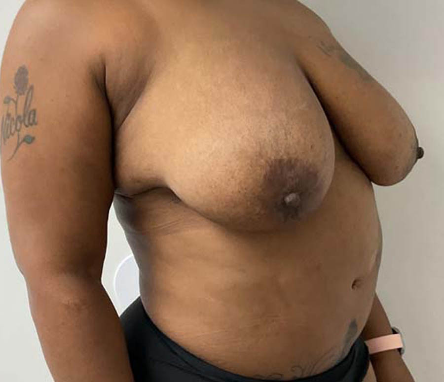 Breast Reduction case #3877