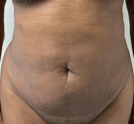 Liposuction case #5879