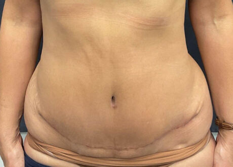 Tummy Tuck case #6101