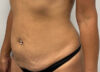 Tummy Tuck case #6101