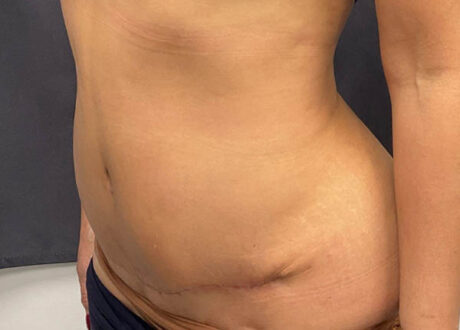 Tummy Tuck case #6101