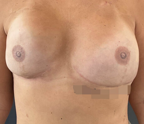 Breast Reconstruction case #5917