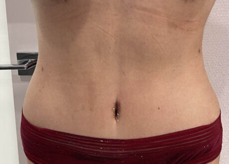 Tummy Tuck case #5903