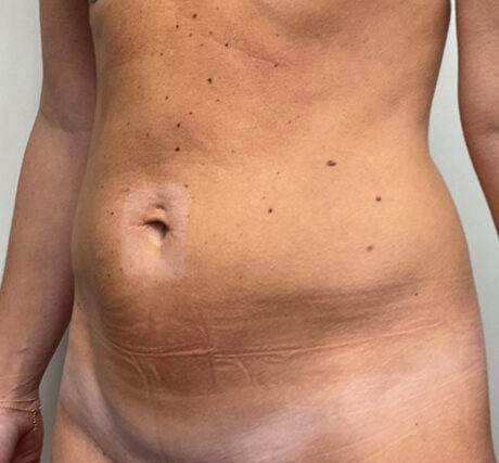 Liposuction case #5955