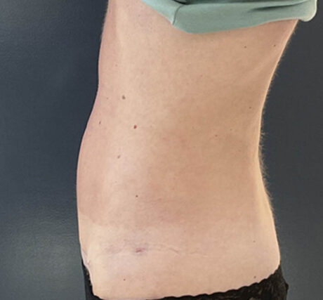 Liposuction case #5955