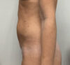 Liposuction case #5955