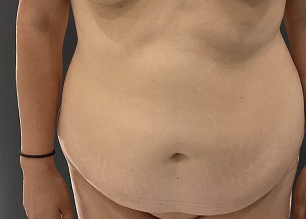 Tummy Tuck case #5903