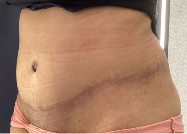 Tummy Tuck case #5544