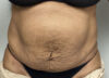 Tummy Tuck case #5544