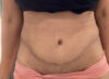 Tummy Tuck case #5544